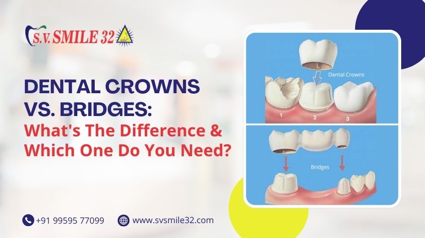Dental Crowns vs. Bridges